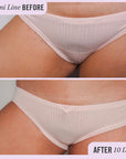 Ingrown Hair Pads with BHA & AHA